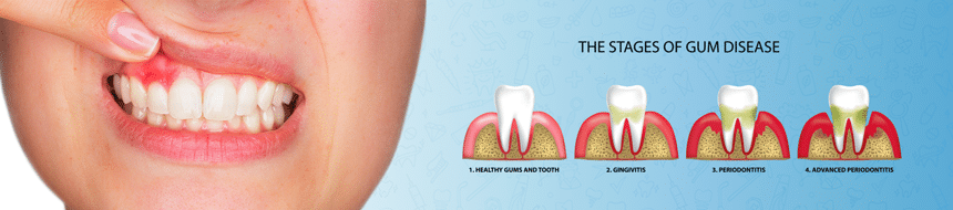root-canal-banner