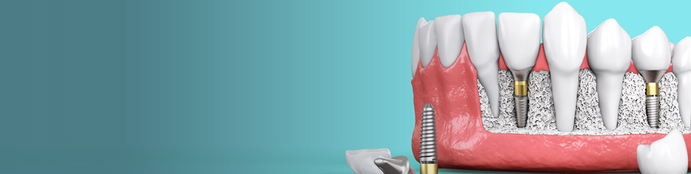 root-canal-banner